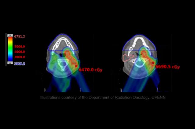 Treating head and neck cancer with proton therapy | IBA Campus