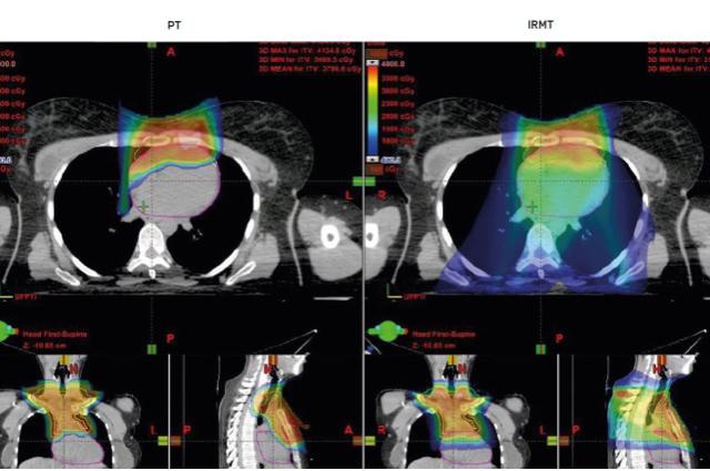 Treating Hodgkin and non-Hodgkin lymphoma with proton therapy