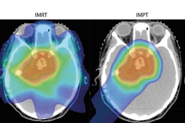 Treating pediatric tumors with proton therapy_whitepaper