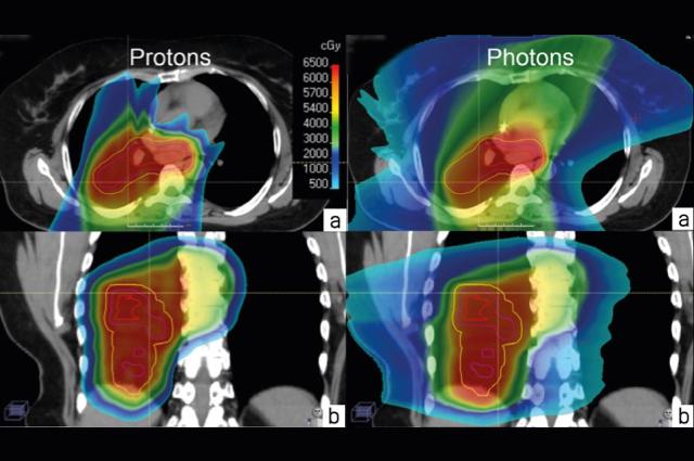 Treating thoracic cancers with proton therapy