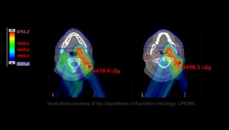 Treating head and neck cancer with proton therapy_whitepaper