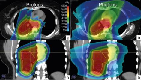 Treating thoracic cancers with proton therapy