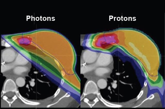 Treating breast cancer with proton therapy