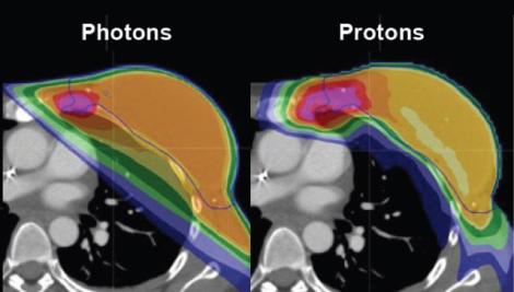 Treating breast cancer with proton therapy